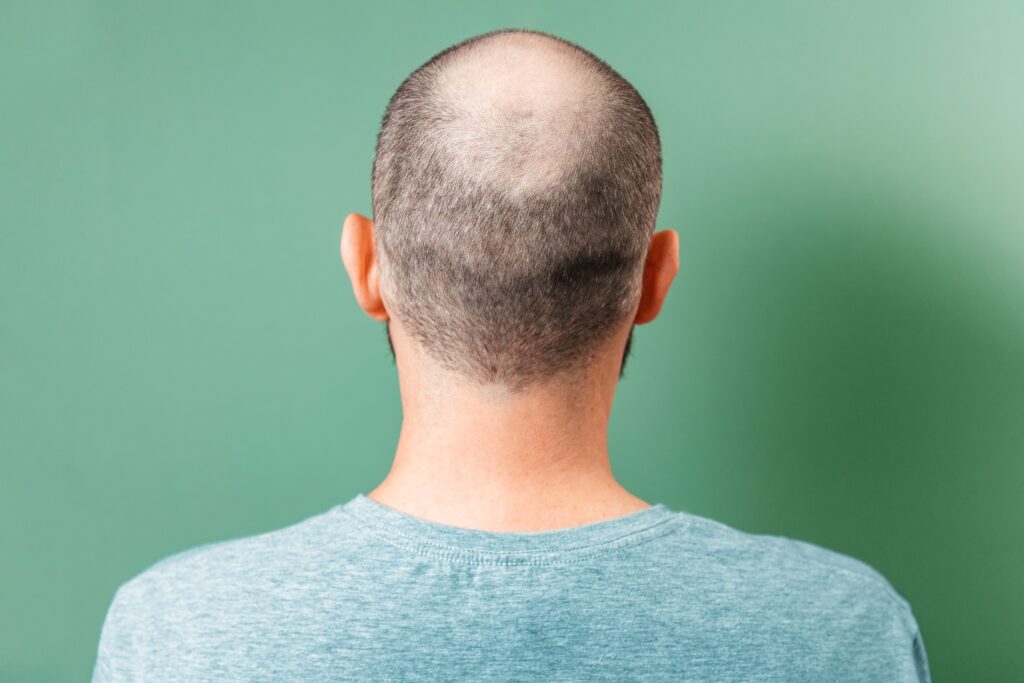 Αδύναμα μαλλιά: Οι ερευνητές βρήκαν τον τρόπο να τα ενισχύσουν!