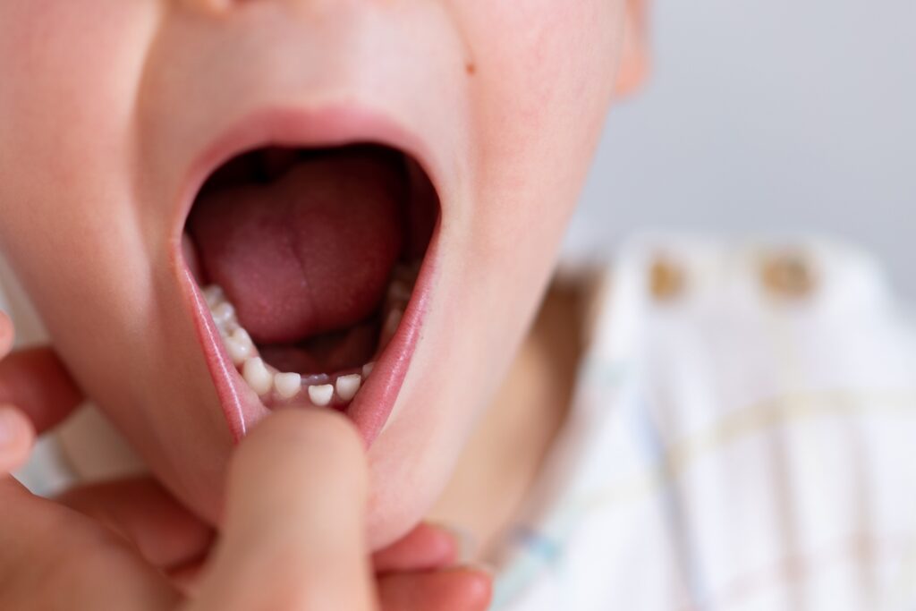 Αμυγδαλίτιδα στο παιδί: Τι λένε οι επιστήμονες της Mayo Clinic