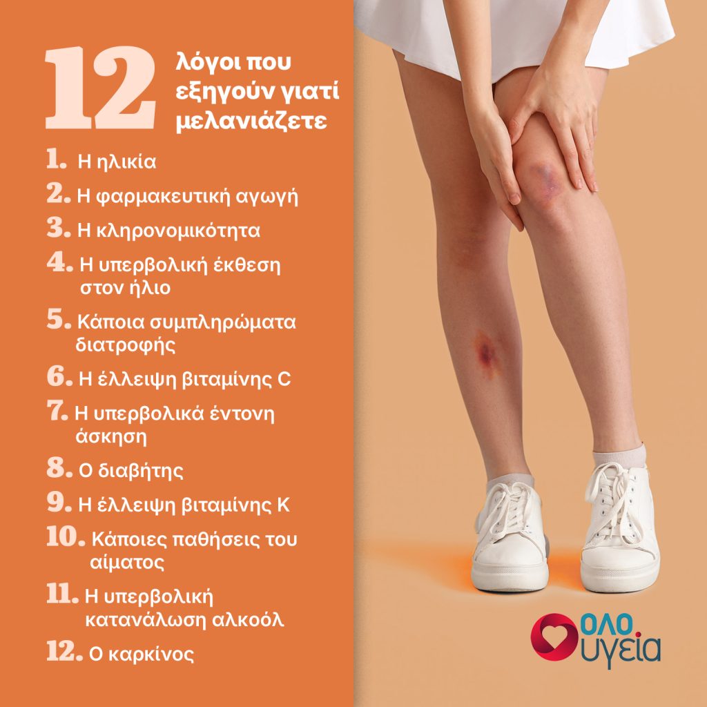 12 αιτίες που εμφανίζετε μελανιές - Πότε είναι σύμπτωμα σοβαρών νόσων