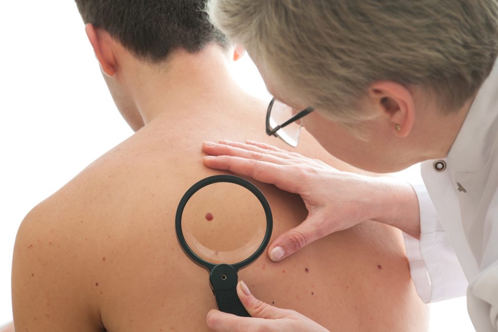 Καρκίνος του δέρματος: Η πιο θανατηφόρα μορφή δεν είναι το μελάνωμα – Εύρημα έκπληξη