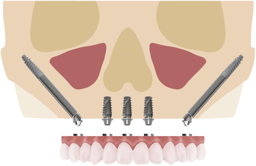 Ζυγωματικά οδοντικά εμφυτεύματα: Η σύγχρονη λύση στην αποκατάσταση της απώλειας δοντιών
