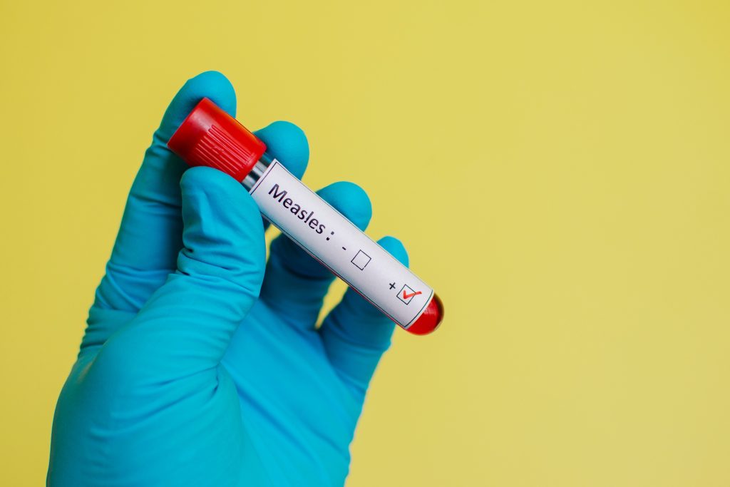 Έξαρση ιλαράς: Πόσο μειώθηκε η εμβολιαστική κάλυψη κατά την πανδημία;