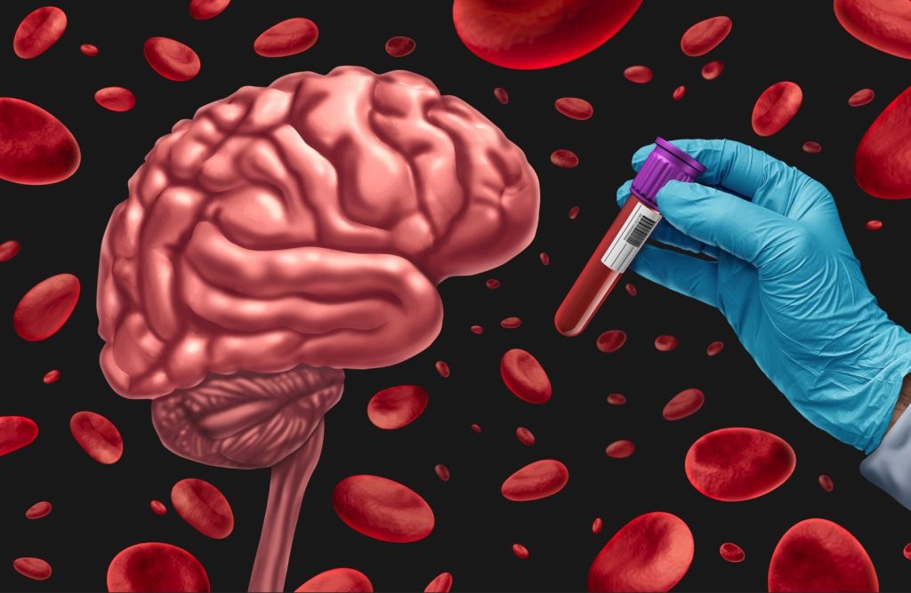 Αλτσχάιμερ: Μπορεί να μεταδοθεί από τις μεταγγίσεις αίματος και τις μεταμοσχεύσεις – Ανησυχητική έρευνα