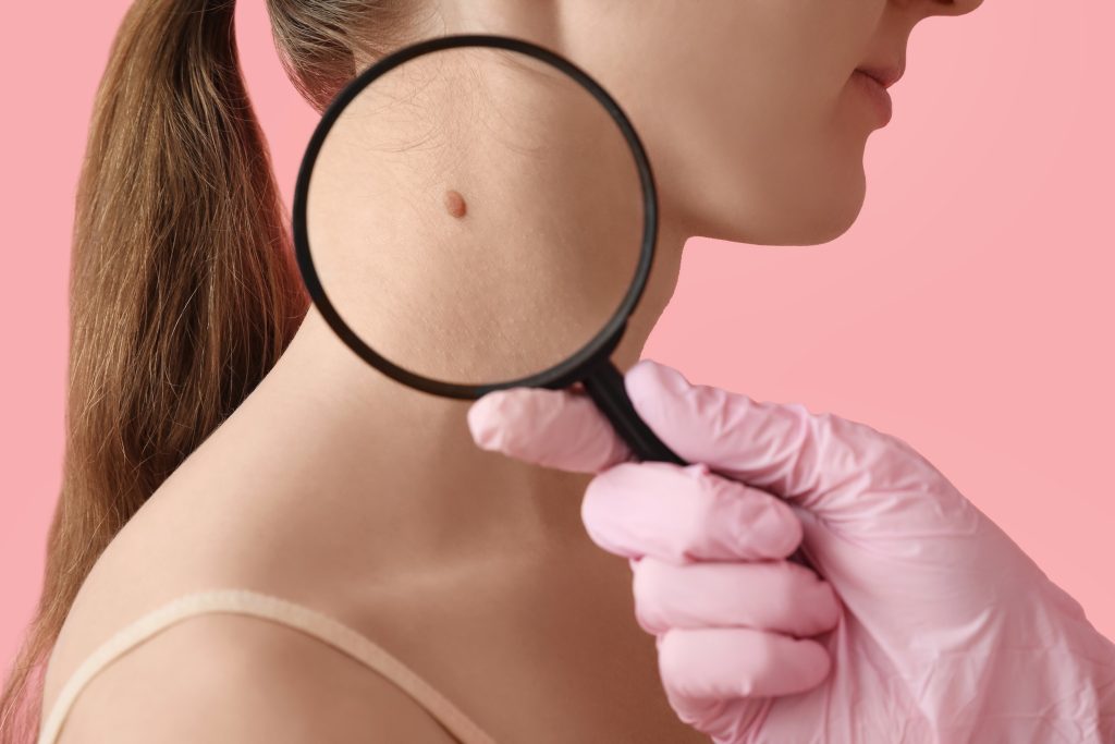 Ανησυχητική διαπίστωση: 1 στους 5 θα εμφανίσει καρκίνο δέρματος κατά τη διάρκεια της ζωής του