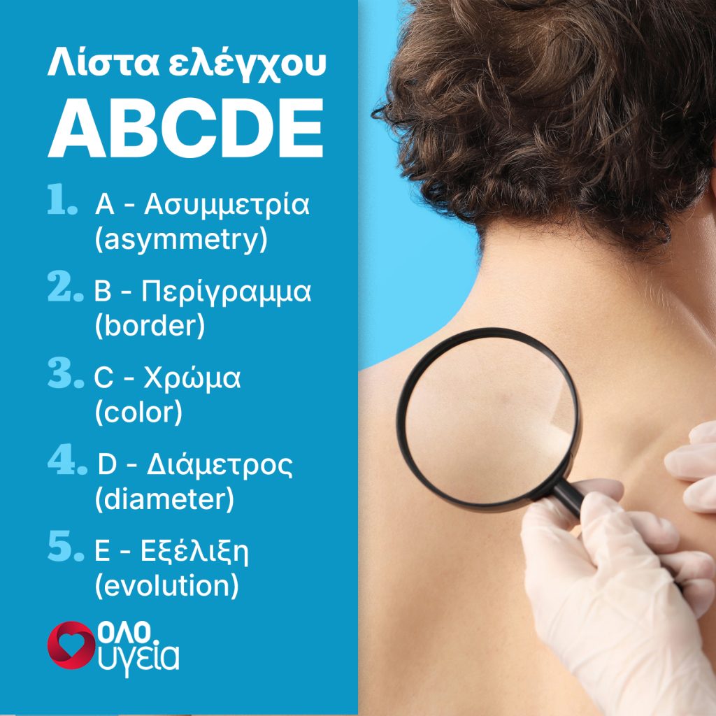 Μελάνωμα: Πώς να καταλάβετε αν μια ελιά είναι επικίνδυνη με πέντε βασικά σημεία