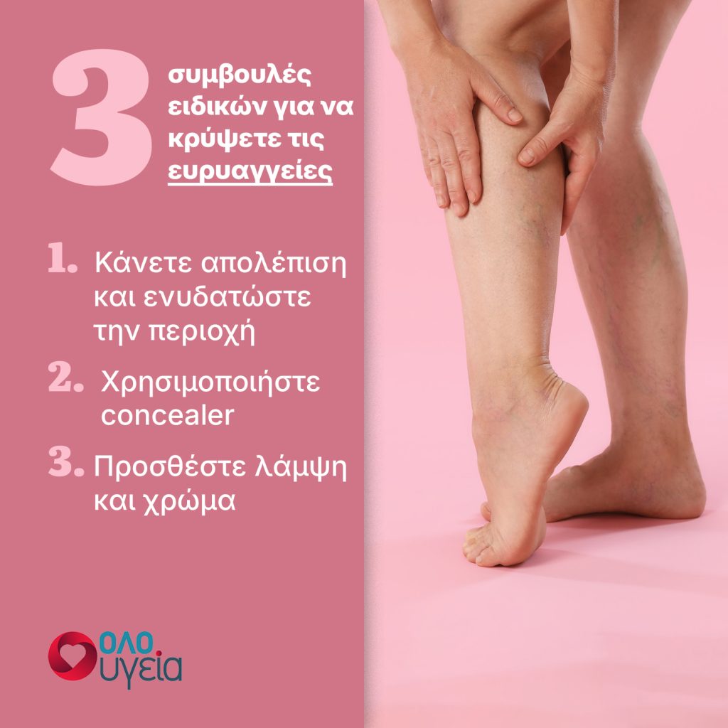 Ευρυαγγείες: 3 τρόποι να τις εξαφανίσετε τις αντιαισθητικές φλεβίτσες