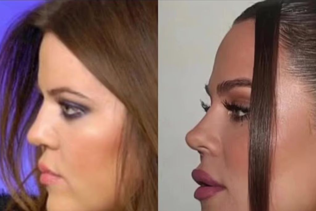 Khloe Kardashian: Κορυφαίος πλαστικός χειρουργός τη διαψεύδει για τις επεμβάσεις – Τι πραγματικά έχει κάνει στο πρόσωπό της