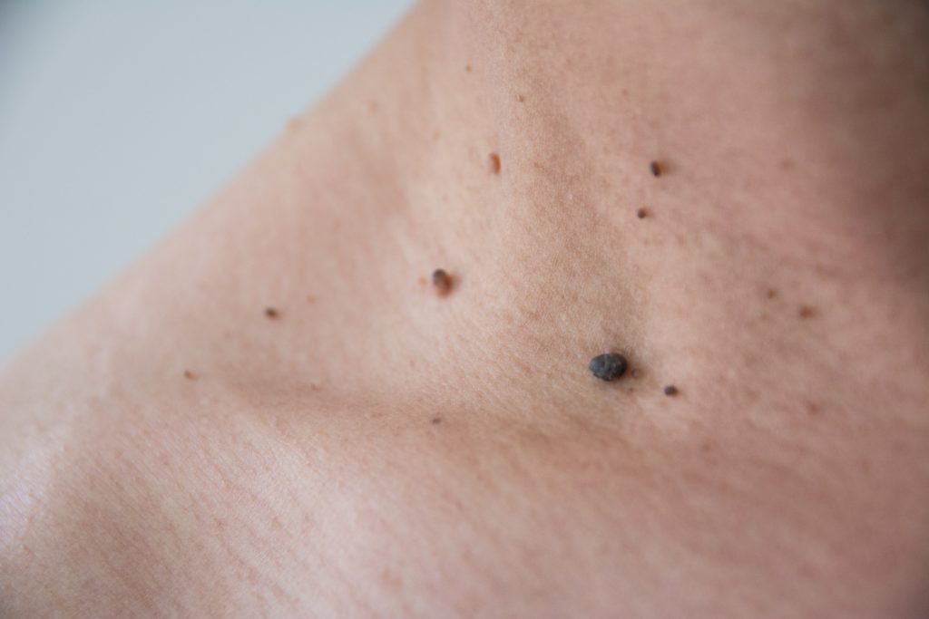 Θηλώματα: Τι είναι, τι μπορεί να τα προκαλούν και πώς αφαιρούνται