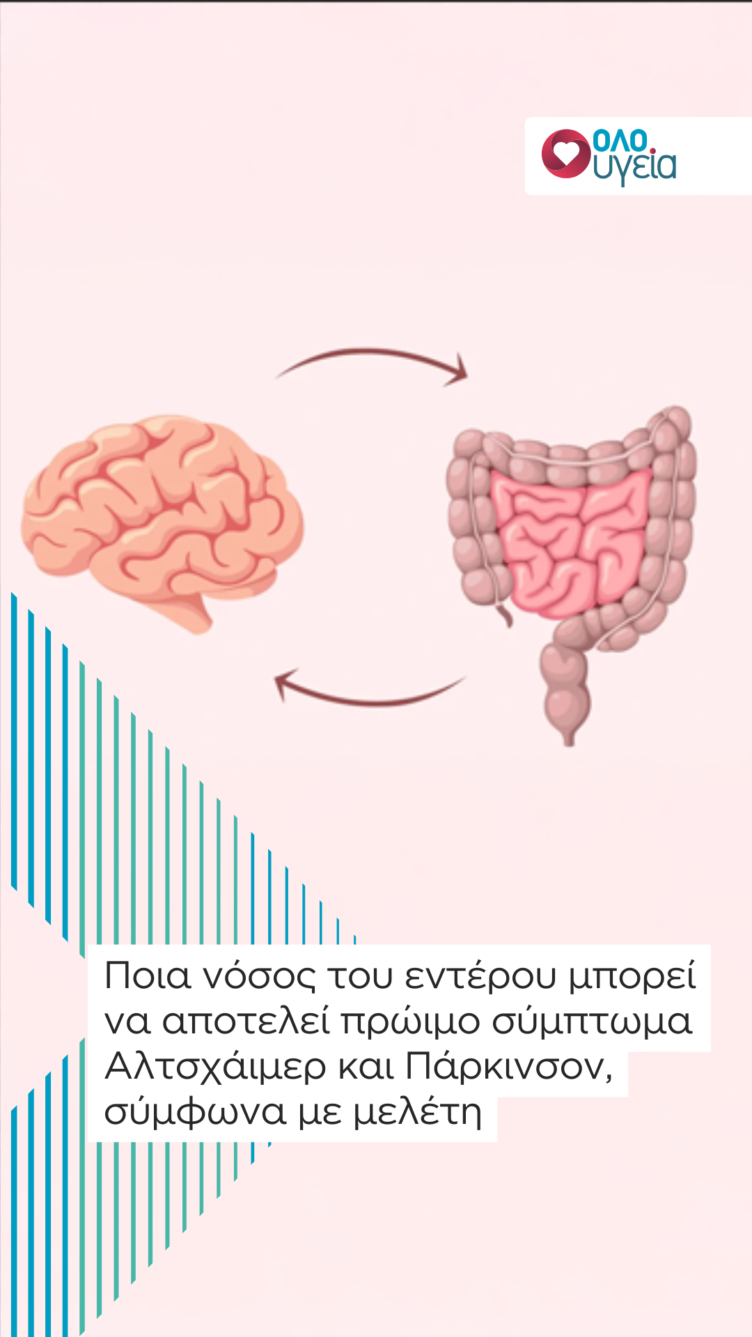 Ποια νόσος του εντέρου μπορεί να αποτελεί πρώιμο σύμπτωμα Αλτσχάιμερ και Πάρκινσον, σύμφωνα με μελέτη