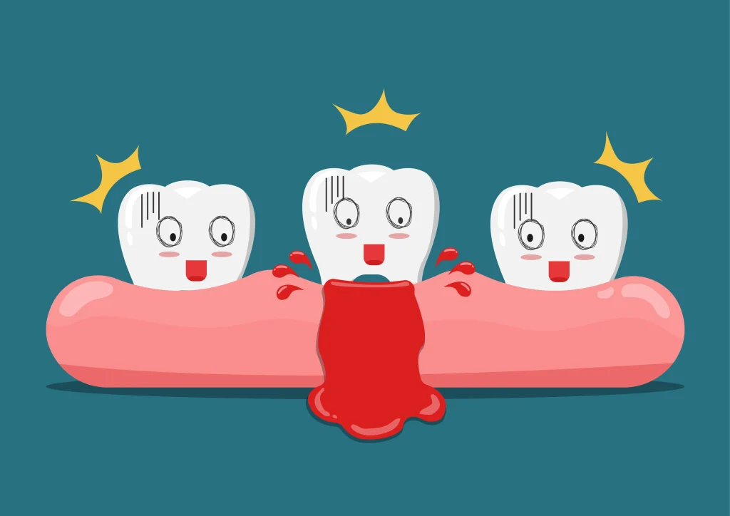 Αιμορραγία στα ούλα: Πότε μπορεί να είναι σύμπτωμα πάθησης