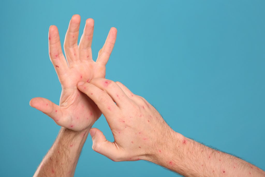 Ευλογιά των πιθήκων: Το νέο στέλεχος έχει εισβάλει στην Ευρώπη – Πώς να προστατευτούμε;