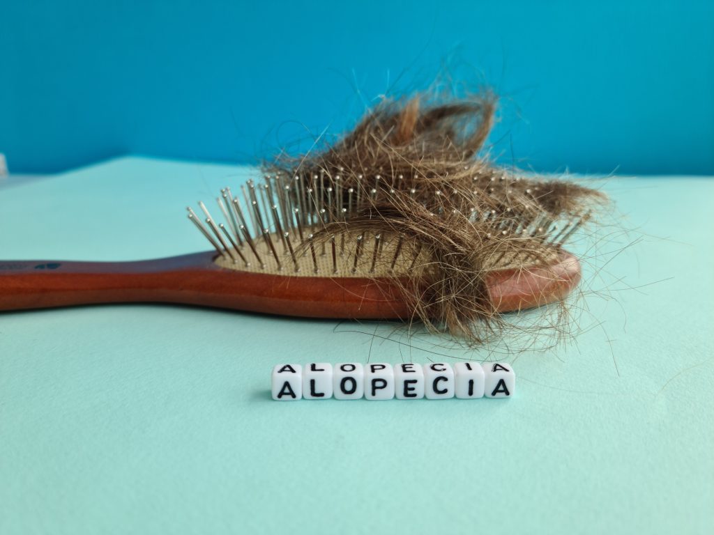 Πώς συνδέεται η γυροειδής αλωπεκία με φλεγμονώδεις νόσους; Νέα μελέτη απαντά