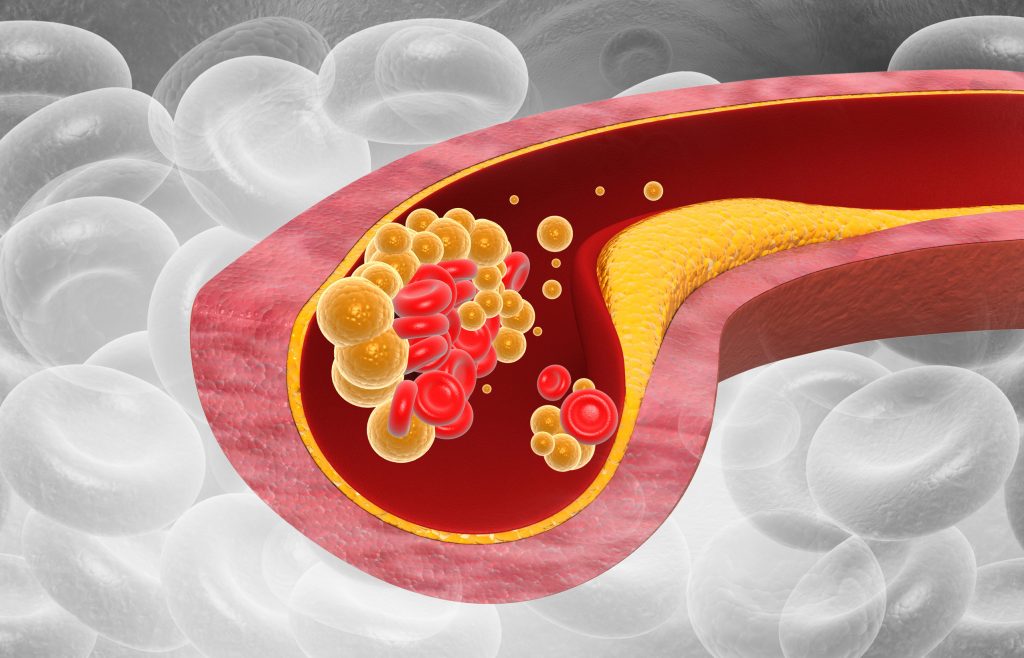 5 σημάδια ότι μπορεί να έχετε χοληστερίνη και πρέπει να κάνετε λιπιδαιμικό έλεγχο