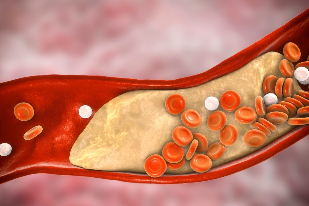 Χοληστερίνη: Οι επιστήμονες ανακάλυψαν πρωτοποριακή θεραπεία που μπορεί να την αντιμετωπίσει με μια μόνο δόση