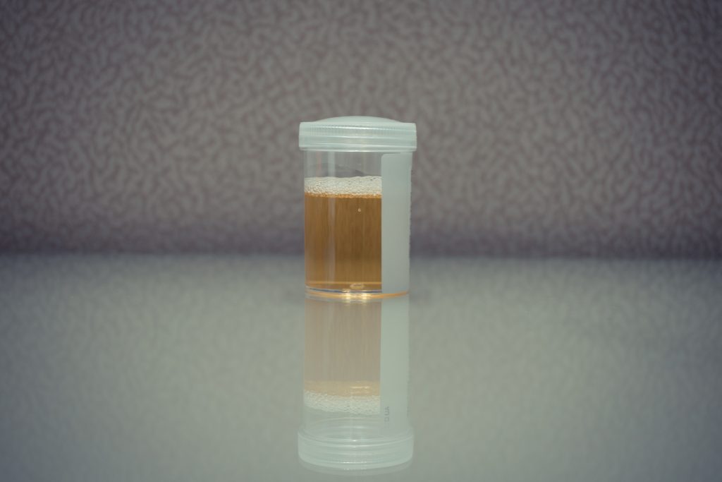 Η διακριτική αλλαγή στα ούρα που μπορεί να είναι πρώιμο σύμπτωμα άνοιας και προβλήματος στα νεφρά – Νέα μελέτη