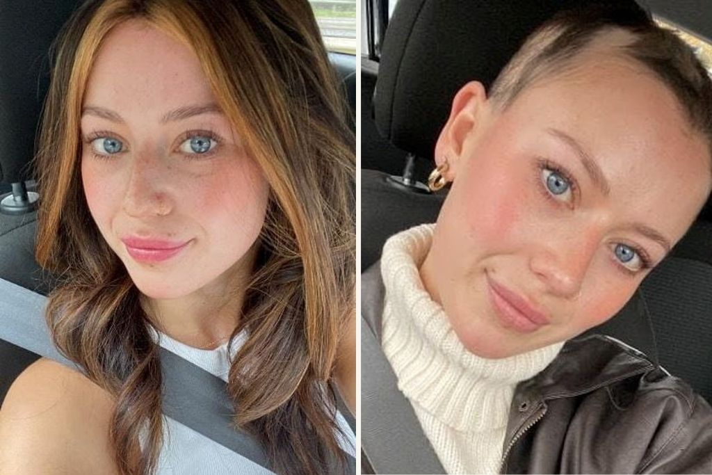 23χρονη με αλωπεκία έμεινε φαλακρή μετά από έντονο εργασιακό άγχος: «Έπαθα νευρικό κλονισμό και κρίση πανικού»