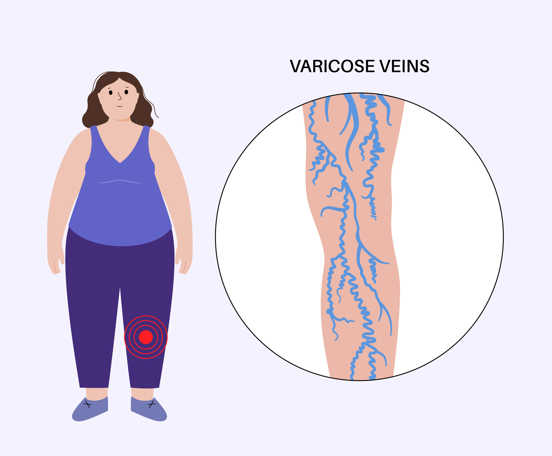 Κιρσοί στα πόδια: Τι τους προκαλεί και πότε χρειάζονται χειρουργείο