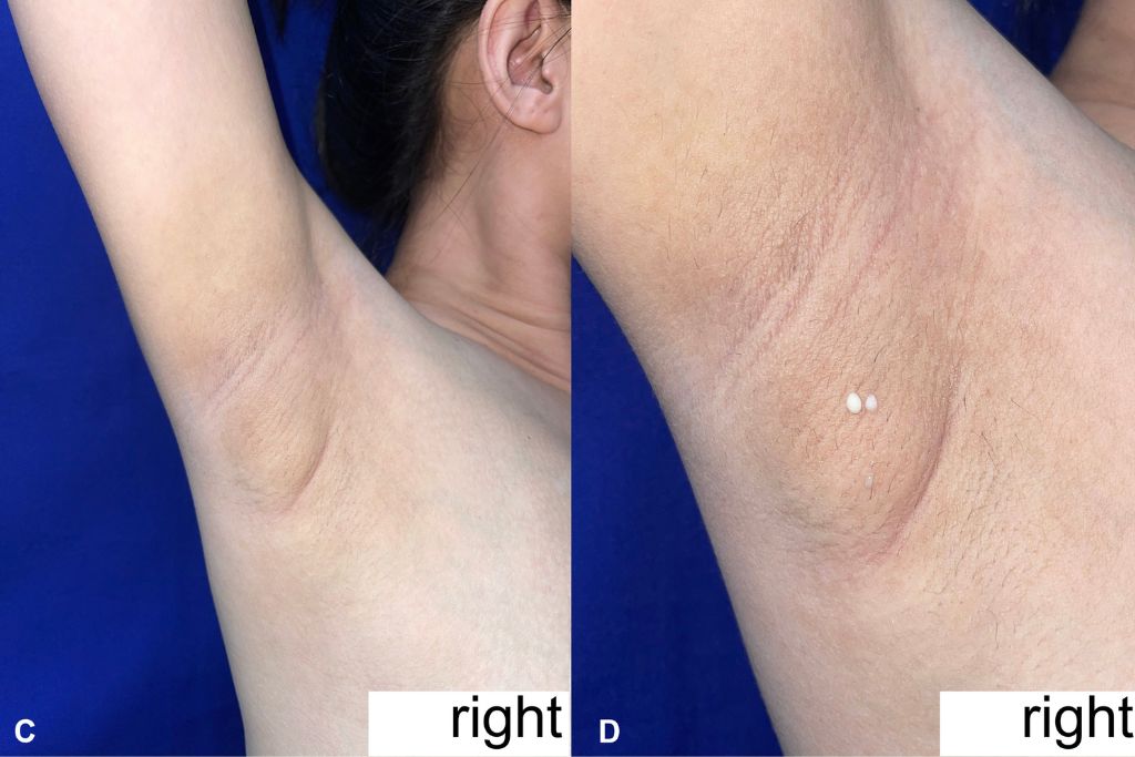 Γυναίκα με σπάνια πάθηση εκκρίνει γάλα από τις μασχάλες – Πού το αποδίδουν οι επιστήμονες; (ΦΩΤΟ)