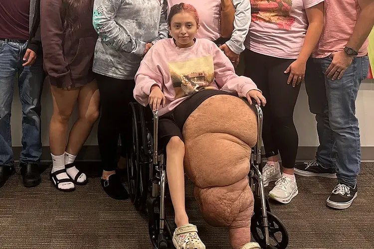 Έφηβη υποβλήθηκε σε αφαίρεση του ποδιού της που ζύγιζε 79 κιλά από σπάνια πάθηση: «Σε κανένα παιδί δεν αξίζει αυτό»