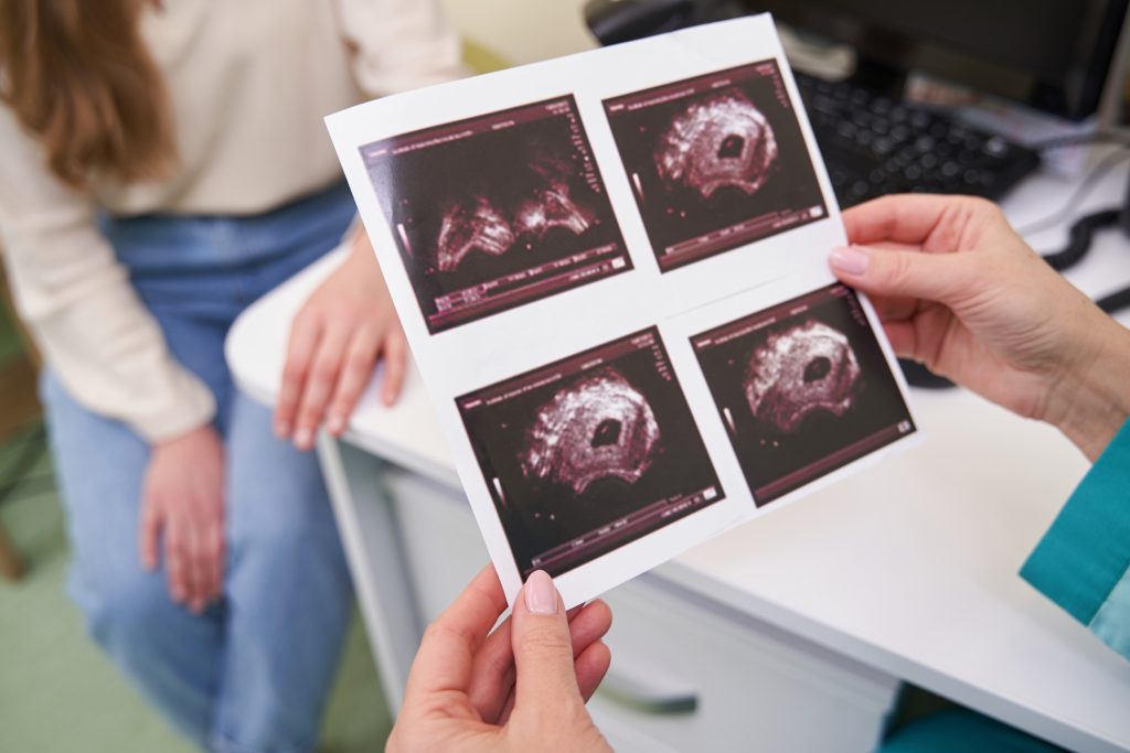 Κατάψυξη ωαρίων: Πώς βοηθά τις γυναίκες να διατηρήσουν τη γονιμότητά τους