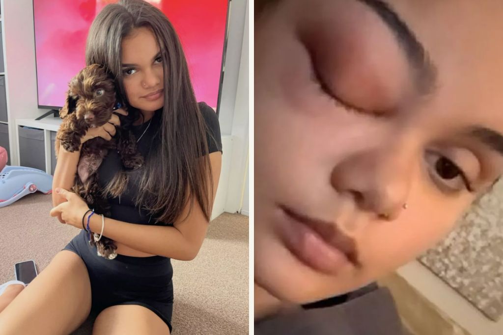 17χρονη με φαγούρα στο μάτι που νόμιζε ότι οφειλόταν σε κρυολόγημα, έλαβε διάγνωση για απειλητική μόλυνση στον εγκέφαλο