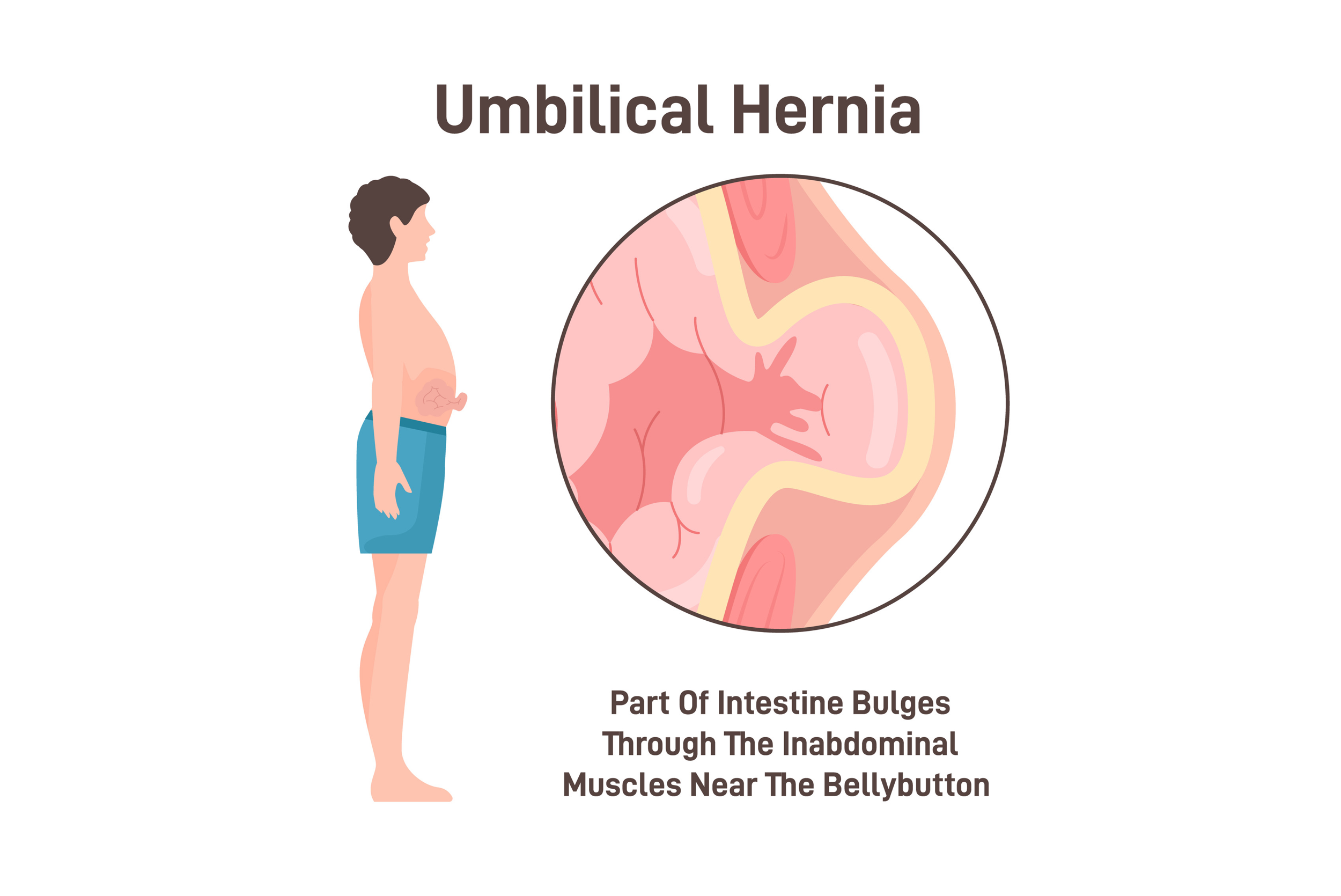 Ομφαλοκήλη: Πότε είναι επικίνδυνη και πότε πρέπει να χειρουργηθεί