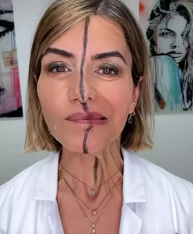 Γιατρός κάνει botox μόνο στο μισό πρόσωπό της για να δείξει τι κάνει πραγματικά στο δέρμα – Αποκαλυπτικό βίντεο