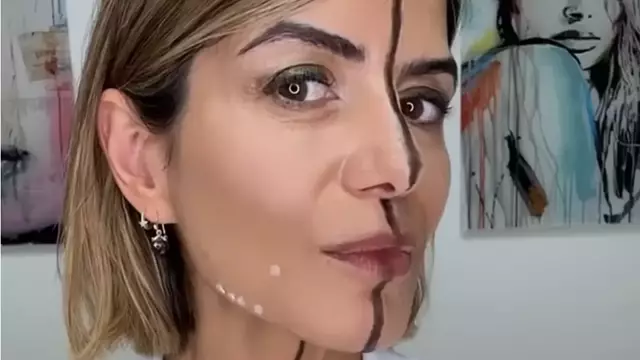 Γιατρός κάνει botox μόνο στο μισό πρόσωπό της για να δείξει τι κάνει πραγματικά στο δέρμα – Αποκαλυπτικό βίντεο