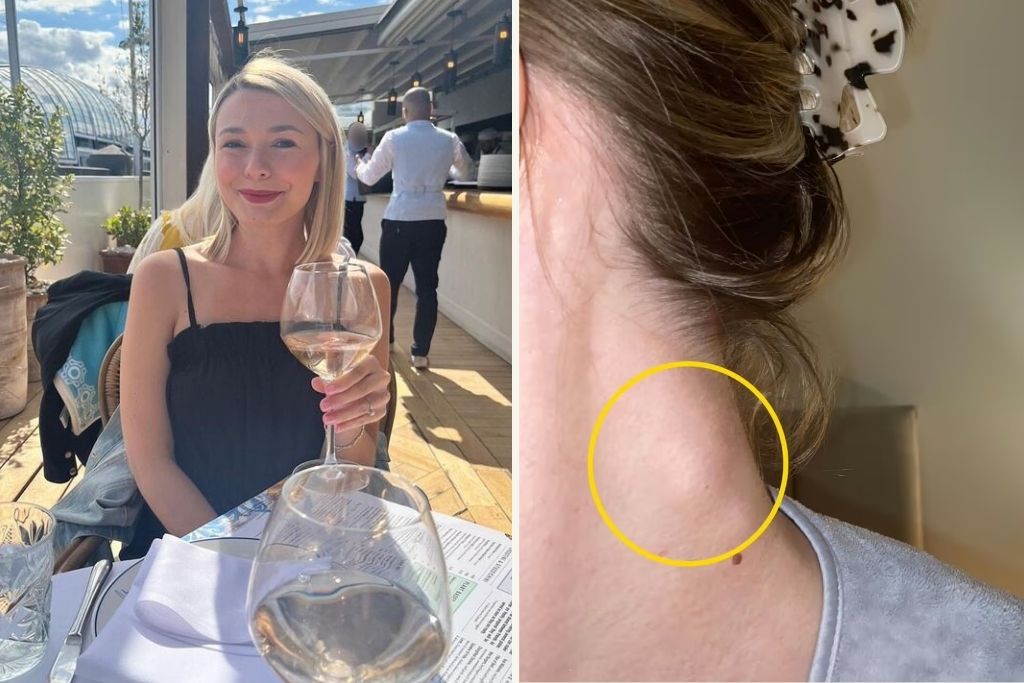 28χρονη που αισθανόταν πόνο και φαγούρα όταν έπινε κρασί, έλαβε διάγνωση για καρκίνο: «Νόμιζαν ότι ήταν ορμονικό»