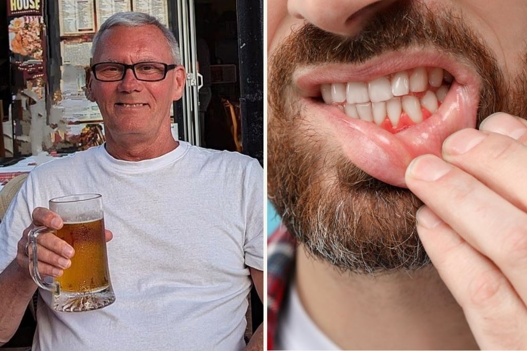 69χρονος που είχε αιμορραγία στα ούλα τελικά έλαβε διάγνωση για προδιαβήτη – Πώς συνδέονται οι δυο παθήσεις;