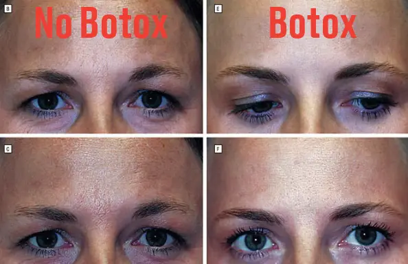 Μελέτη για το botox: Αποκαλυπτικές φωτό σε πανομοιότυπες δίδυμες δείχνουν τι προκαλεί σε 20 χρόνια