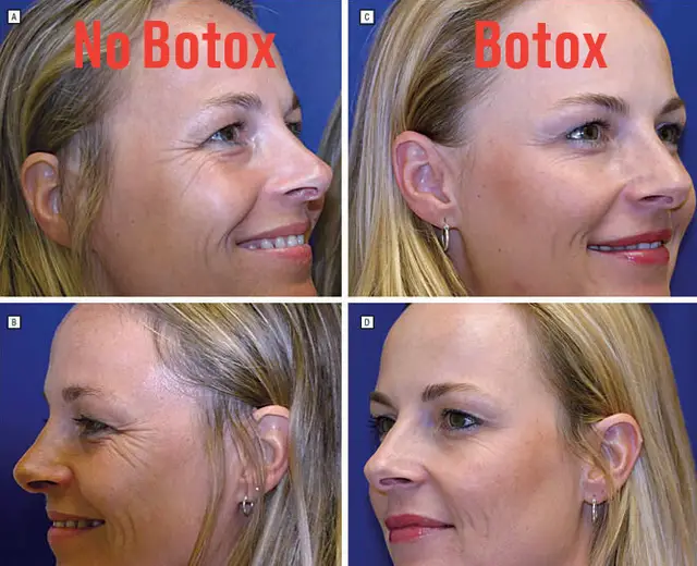 Μελέτη για το botox: Αποκαλυπτικές φωτό σε πανομοιότυπες δίδυμες δείχνουν τι προκαλεί σε 20 χρόνια
