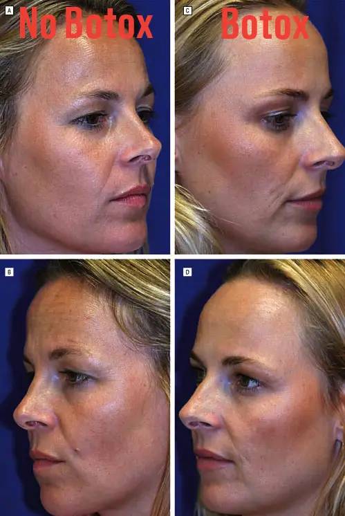 Μελέτη για το botox: Αποκαλυπτικές φωτό σε πανομοιότυπες δίδυμες δείχνουν τι προκαλεί σε 20 χρόνια