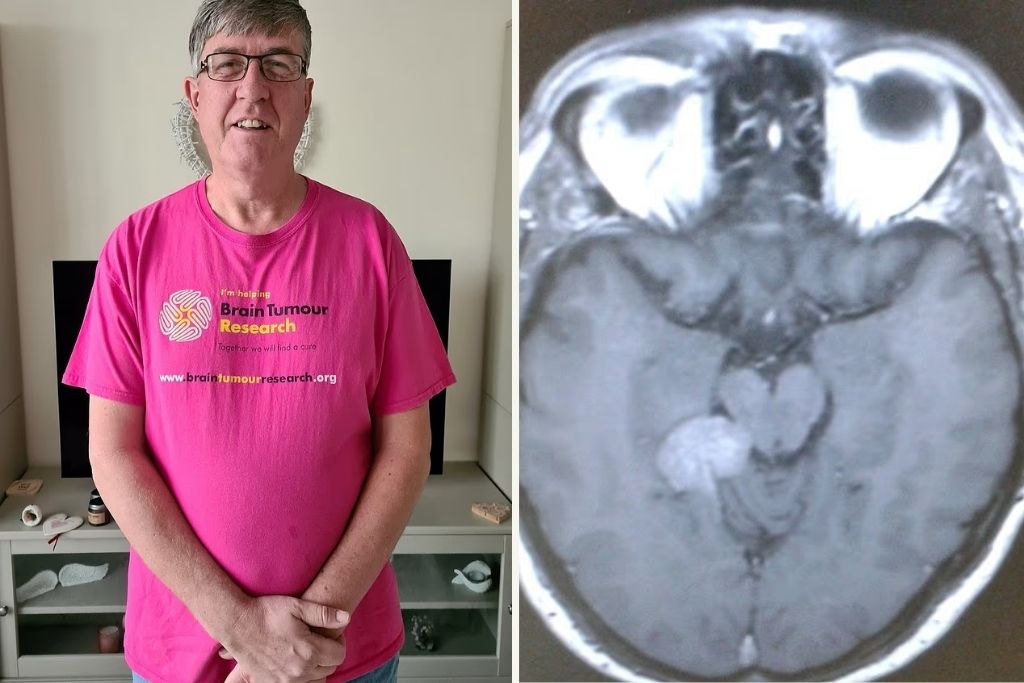 «Νόμιζα ότι ήταν απλές εμβοές»: Η συγκλονιστική μαρτυρία του 59χρονου που έλαβε διάγνωση για όγκο στον εγκέφαλο