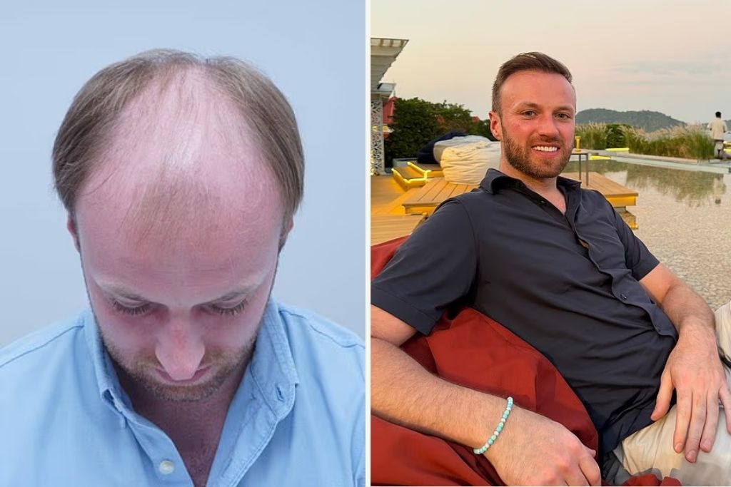 Μεταμόσχευση μαλλιών: Ο 33χρονος που έδειχνε 40 και τώρα τον περνούν για 20άρη – Δείτε την απίστευτη μεταμόρφωση