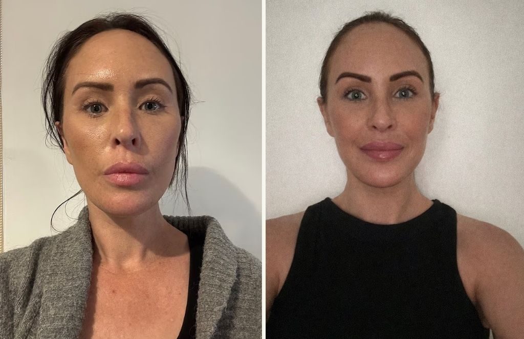 45χρονη ξόδεψε μια περιουσία για να κάνει 5 πλαστικές: «Μου λένε ότι δείχνω μεγαλύτερη τώρα» – Τι της συνέβη;