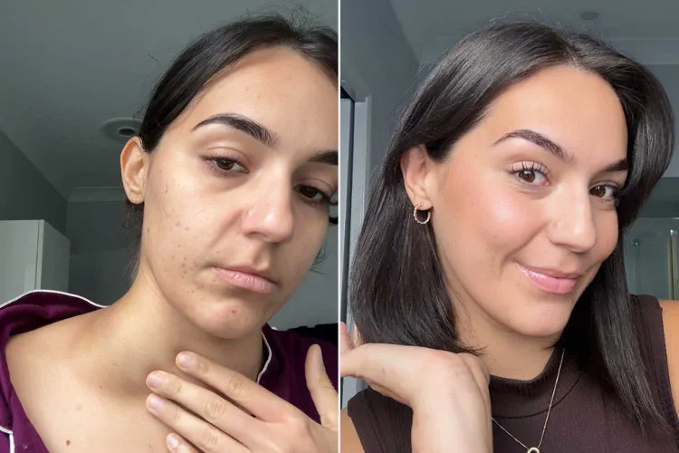 26χρονη με αφόρητη φαγούρα διαγνώστηκε μόνη της με καρκίνο αφού οι γιατροί την αγνόησαν: «Με βοήθησε η google»