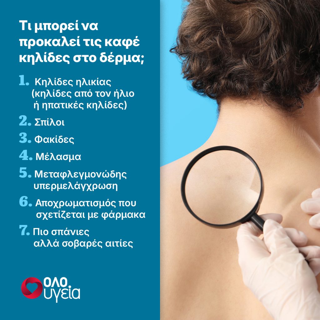 Καφέ κηλίδες στο δέρμα: Πότε είναι αθώες και πότε μπορεί να κρύβουν καρκίνο – Ειδικοί εξηγούν
